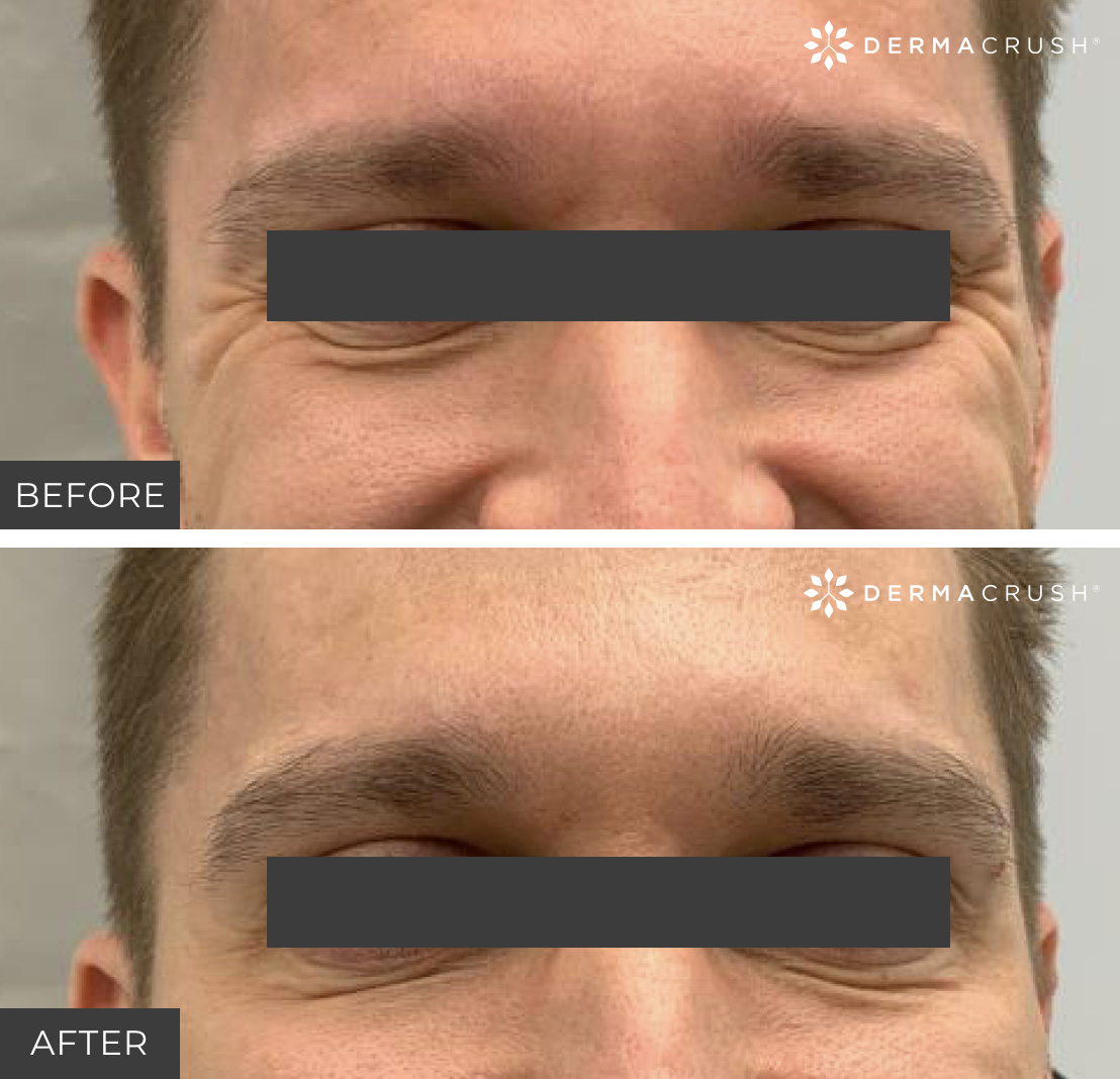 Before and after Botox for men in Scottsdale