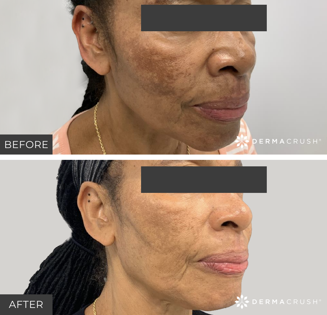 Before and after Clear and Brilliant Laser treatment in Scottsdale