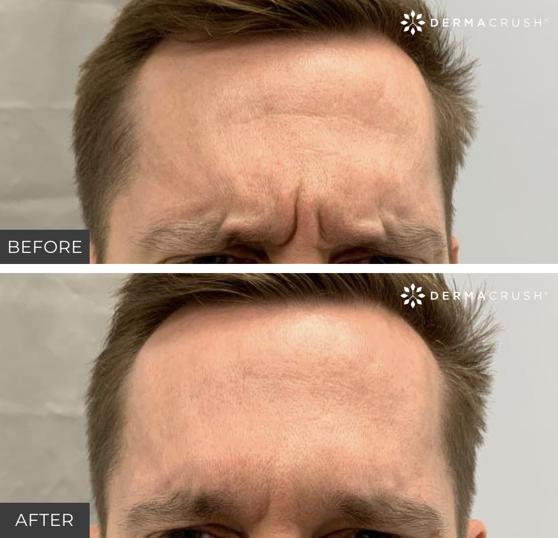 Before and after Dysport for men in Scottsdale