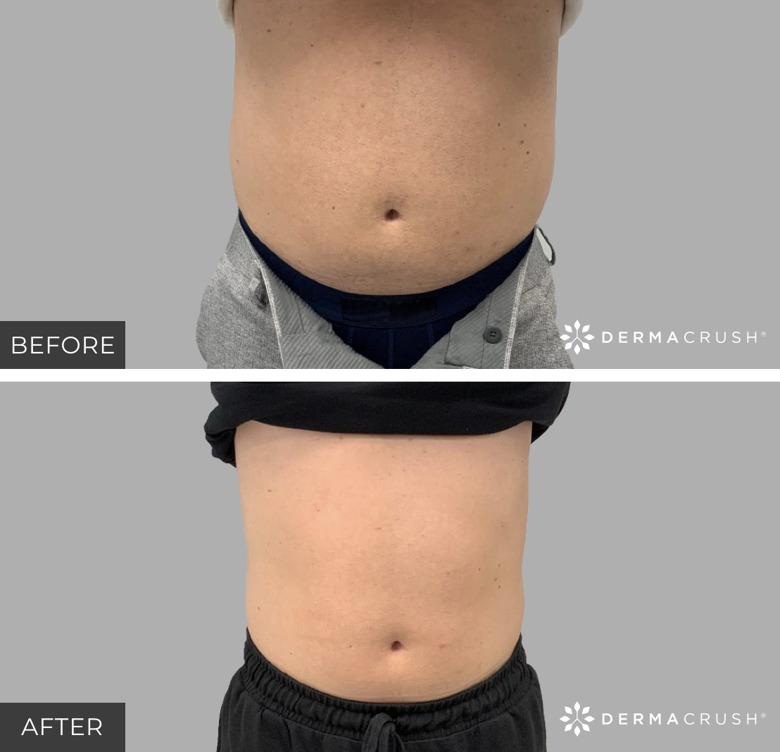 Before and after Emsculpt in Scottsdale
