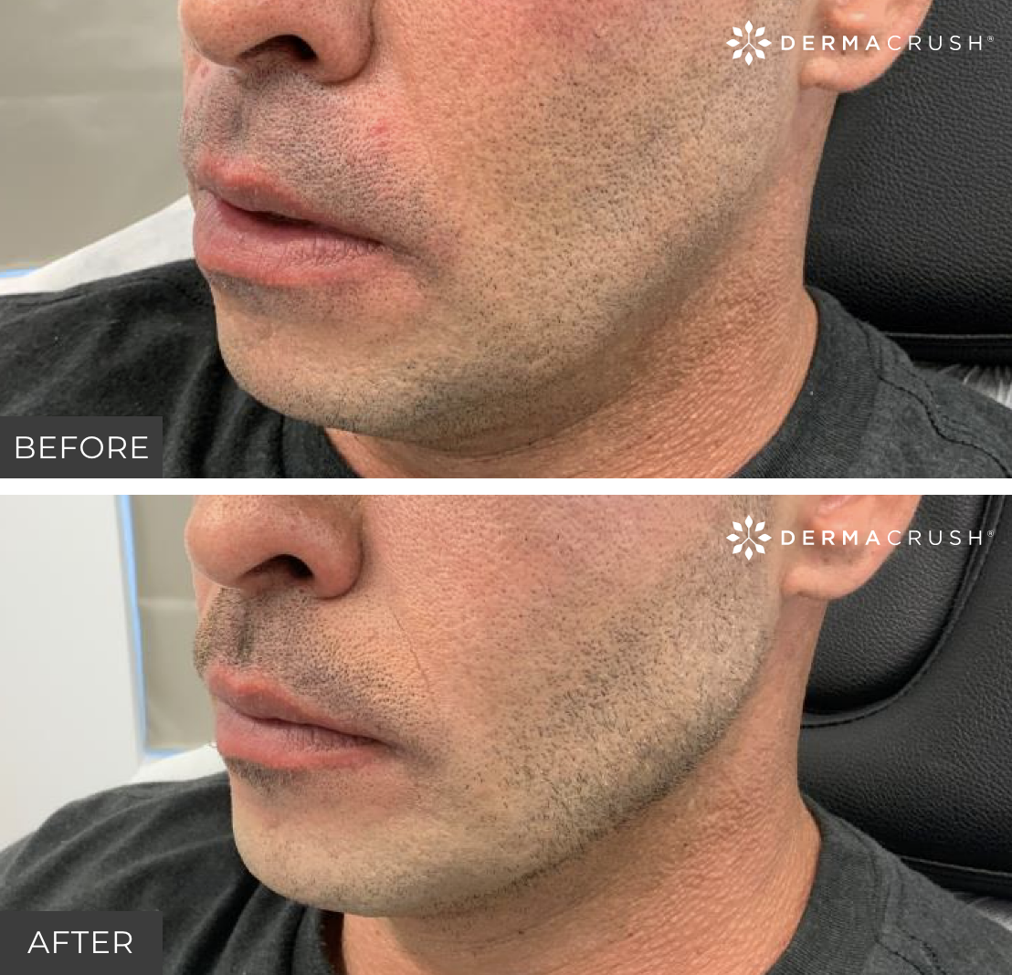Before and after Men's Fillers in Scottsdale