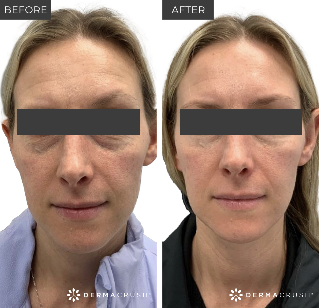 Before and after Women's Fillers in Scottsdale