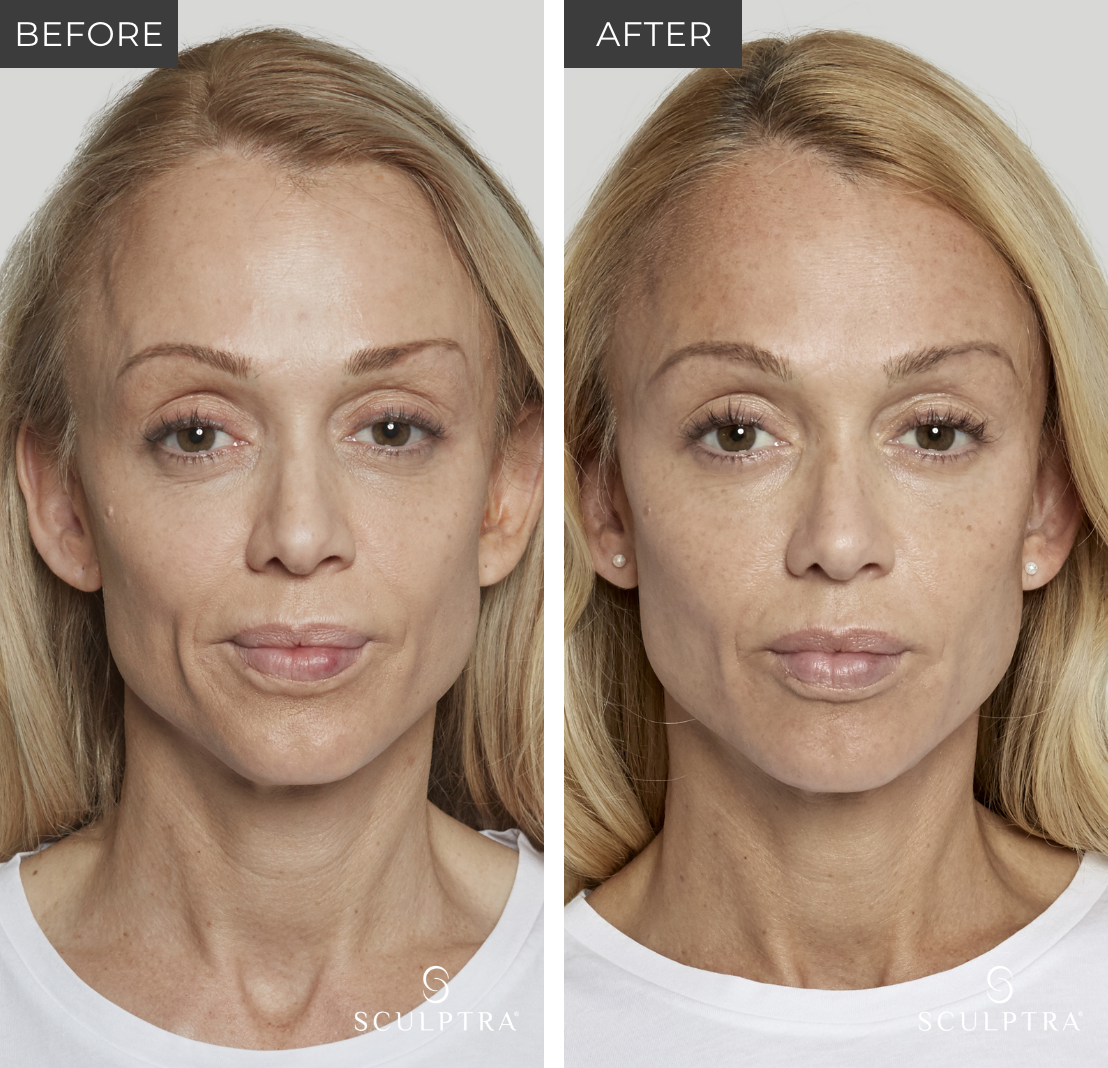 Before and after Sculptra in Scottsdale