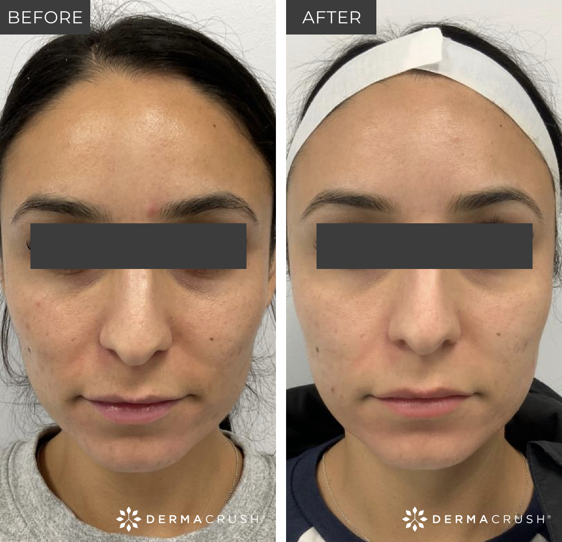 Before and After SkinPen in Scottsdale