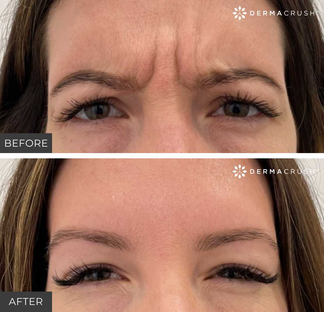 Before and After Botox Treatment in Scottsdale