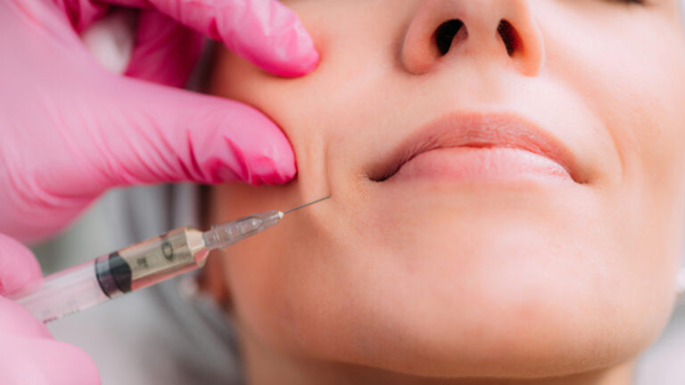 Dermal Fillers for Smile Lines